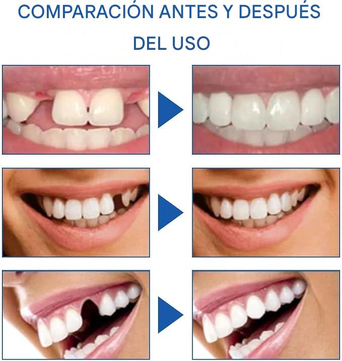 NovaSmile® | Premium Kit de Protesis Dental