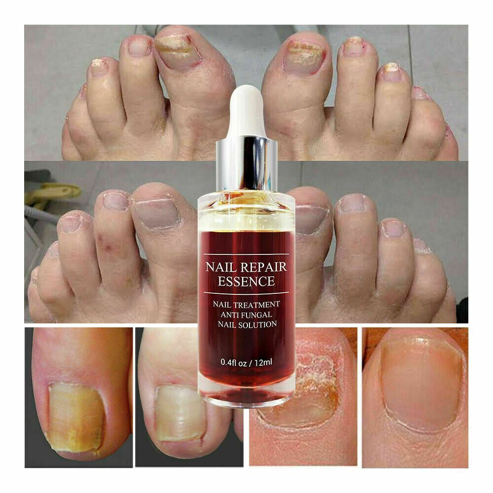 LANBENA™ | Serum Repara Uñas -Antihongos fórmula antifúngica