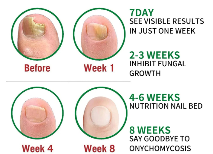 Fungus Free Nails® |  ¡No ignores el problema! Recupera la salud y belleza de tus uñas !