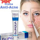 Bioaqua® | 2x1 Crema AntiAcné & Reparadora de Cicatrices de Acné