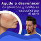 Bioaqua® | 2x1 Crema AntiAcné & Reparadora de Cicatrices de Acné