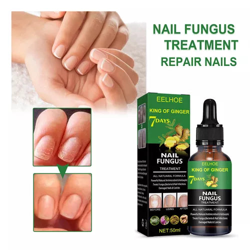 Fungus Free Nails® |  ¡No ignores el problema! Recupera la salud y belleza de tus uñas !