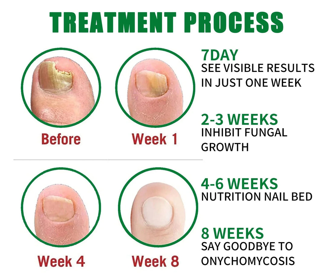 Fungus Free Nails® |  ¡No ignores el problema! Recupera la salud y belleza de tus uñas !