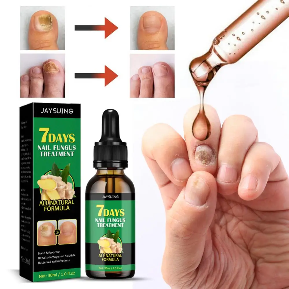 Fungus Free Nails® |  ¡No ignores el problema! Recupera la salud y belleza de tus uñas !