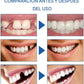 NovaSmile® | Premium Kit de Protesis Dental