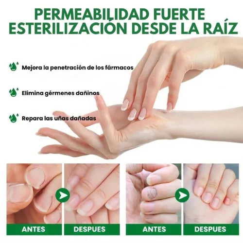 Fungus Free Nails® |  ¡No ignores el problema! Recupera la salud y belleza de tus uñas !