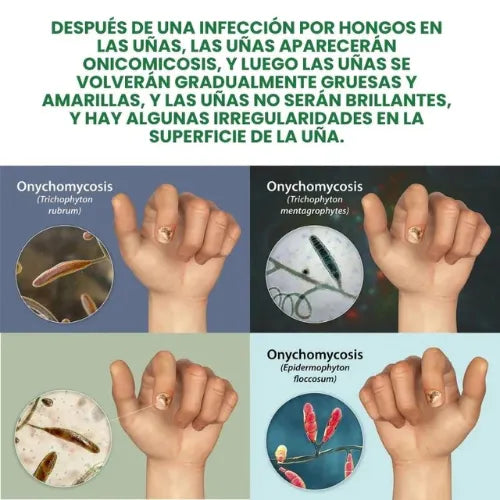 Fungus Free Nails® |  ¡No ignores el problema! Recupera la salud y belleza de tus uñas !
