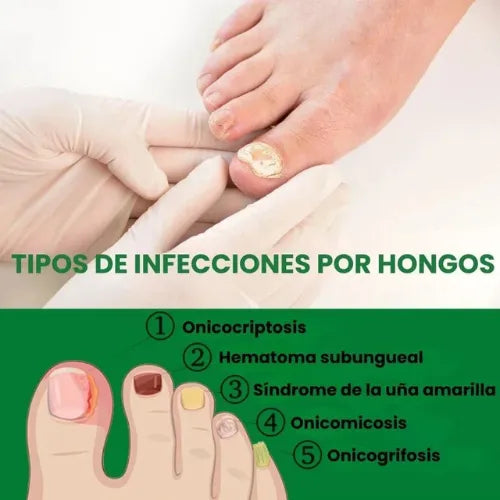 Fungus Free Nails® |  ¡No ignores el problema! Recupera la salud y belleza de tus uñas !