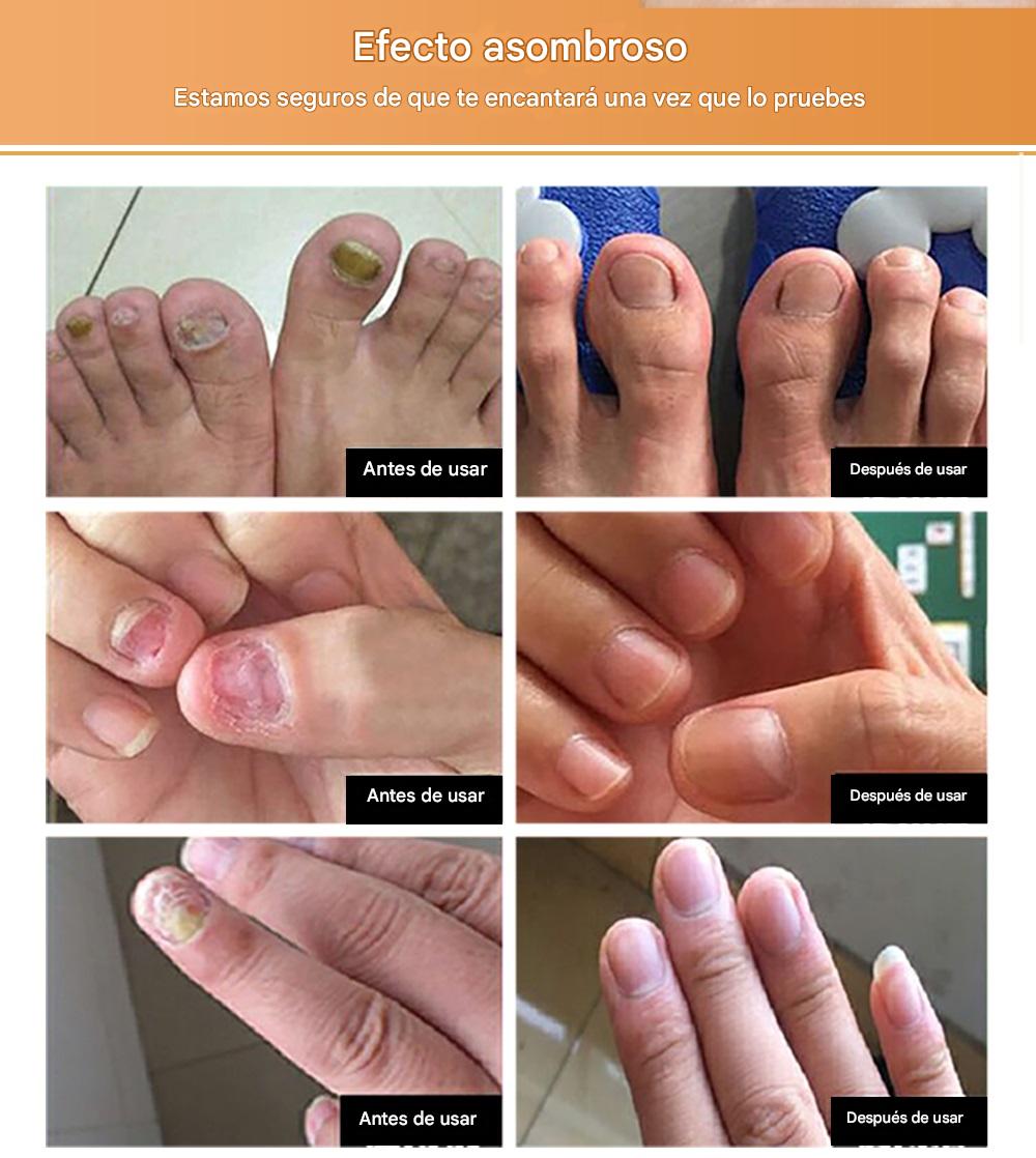 LANBENA™ | Serum Repara Uñas -Antihongos fórmula antifúngica